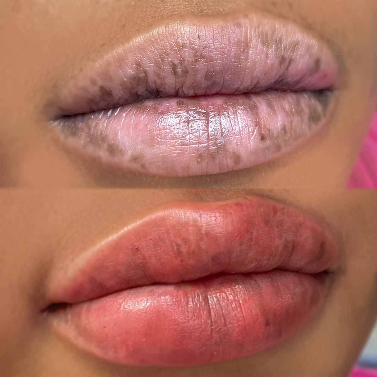 Dark lip neutralization before and after close-up