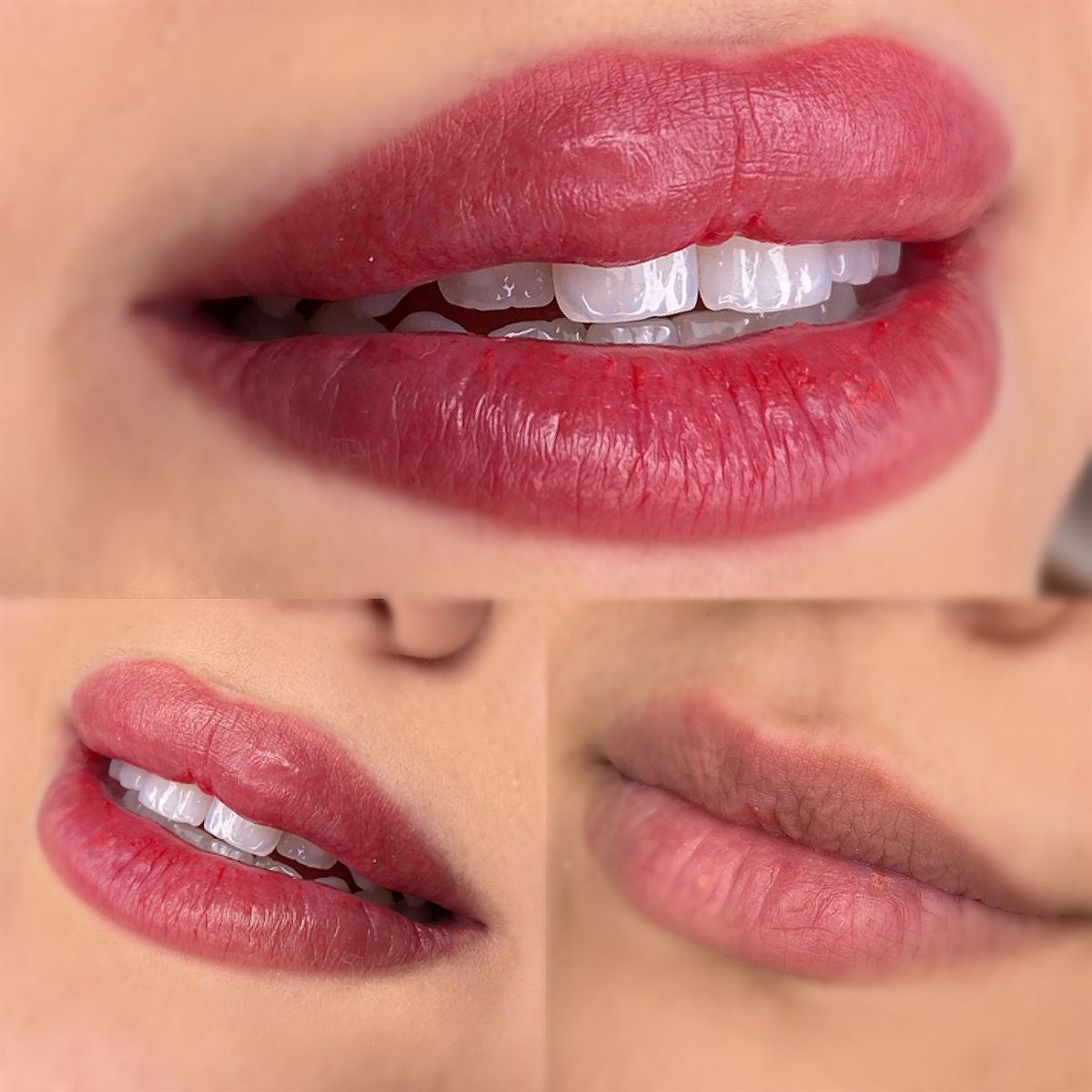 Lip blush results — multiple angles plus before shot